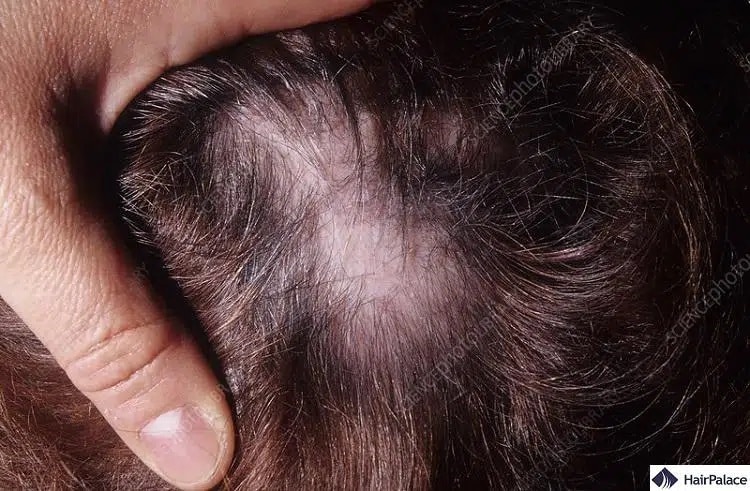il lupus può causare la perdita dei capelli