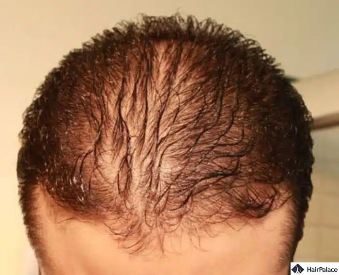 l'interruzione del ciclo di crescita dei capelli può portare alla caduta dei capelli