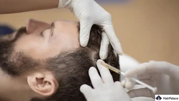 Il trattamento con PRP può trattare la caduta dei capelli con DHT