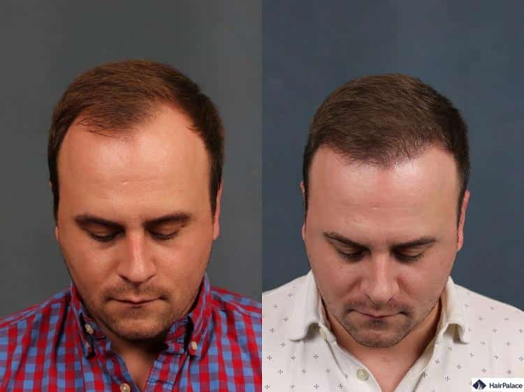 Ripristino dell'attaccatura dei capelli negli uomini sottoposti a trapianto di capelli - Hair Clinic Europe