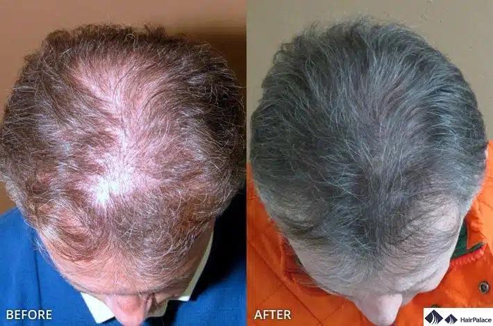 trapianto di capelli maschili invecchiati