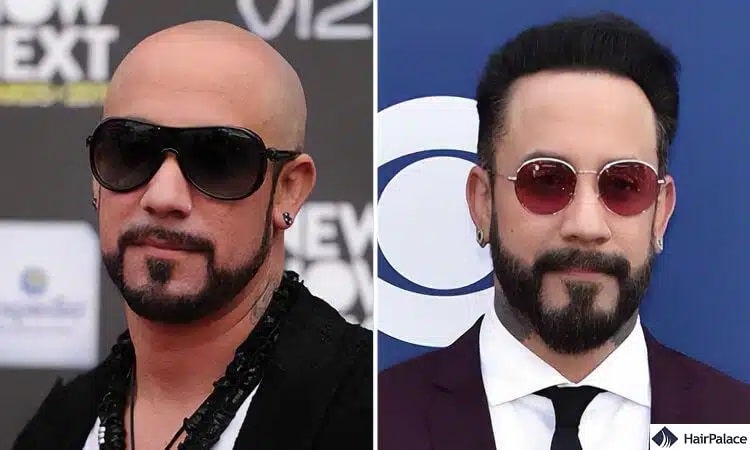 Trapianto di capelli AJ Mclean prima e dopo