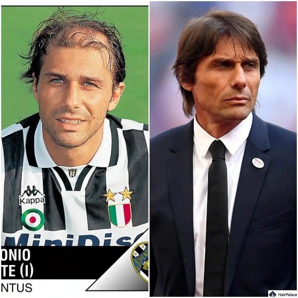 antonio conte trapianto di capelli prima e dopo