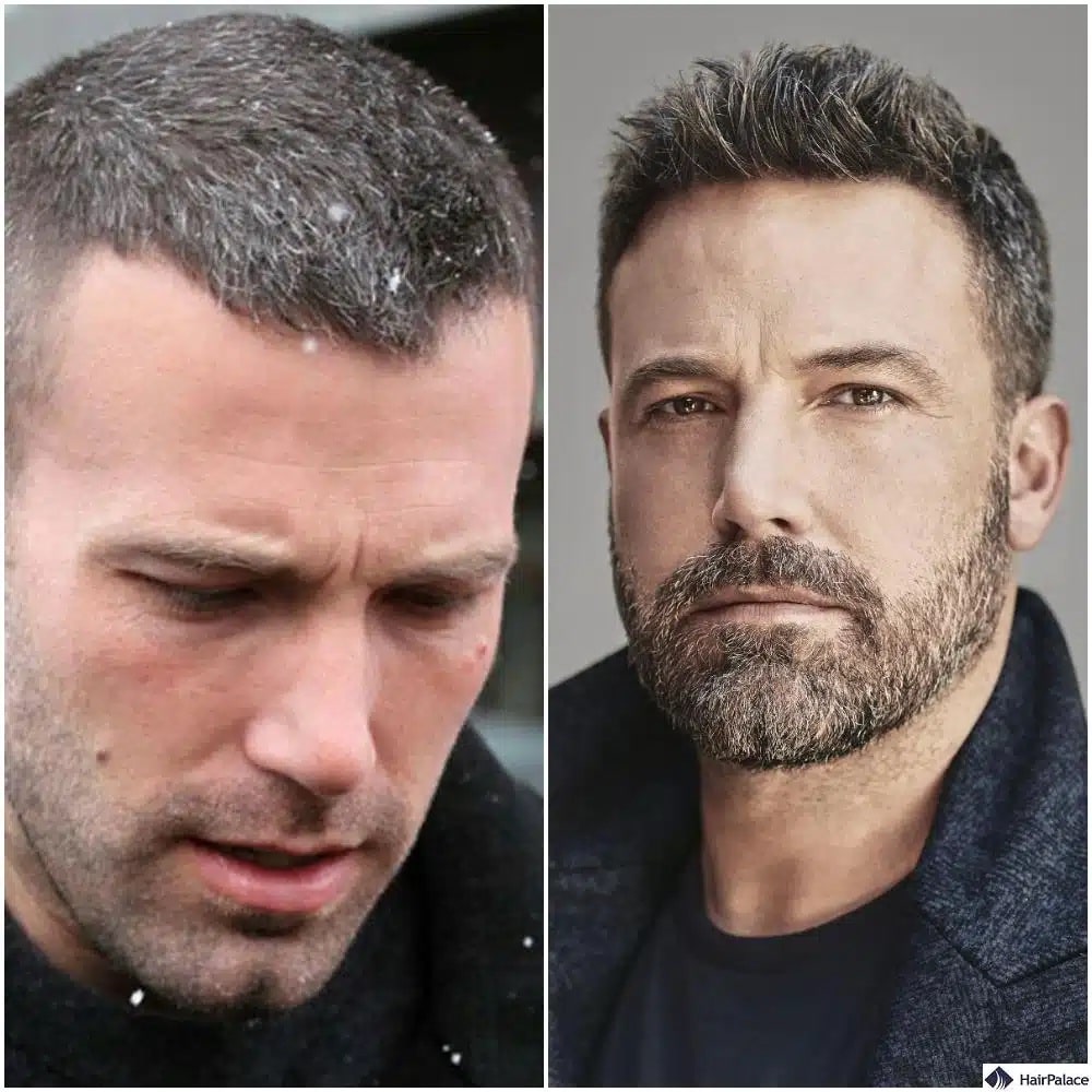 Trapianto di capelli Ben Affleck prima e dopo
