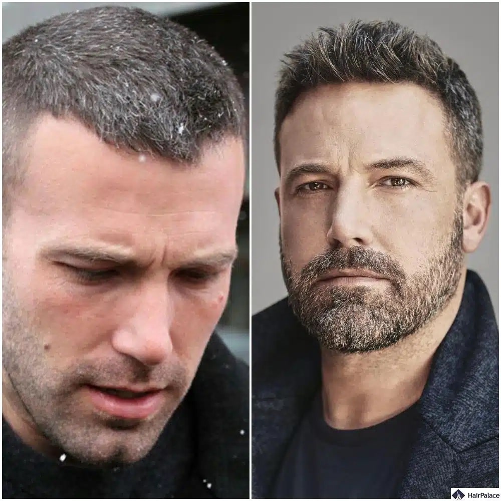 Trapianto di capelli Ben Affleck prima e dopo