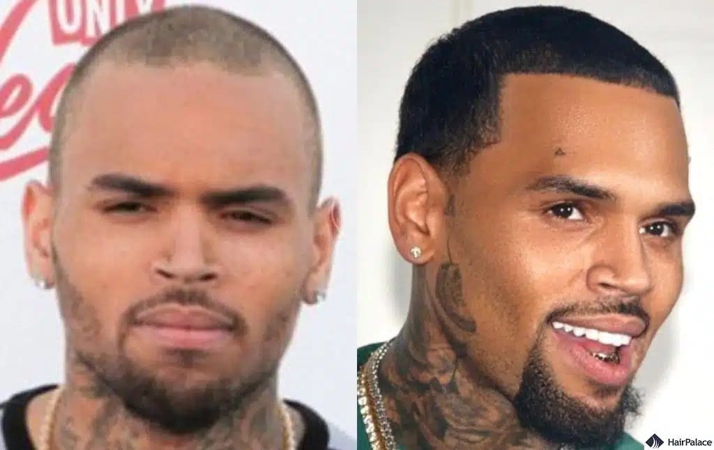 Trapianto di capelli Chris Brown prima e dopo