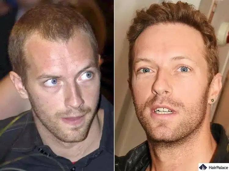 Trapianto di capelli Chris Martin prima e dopo