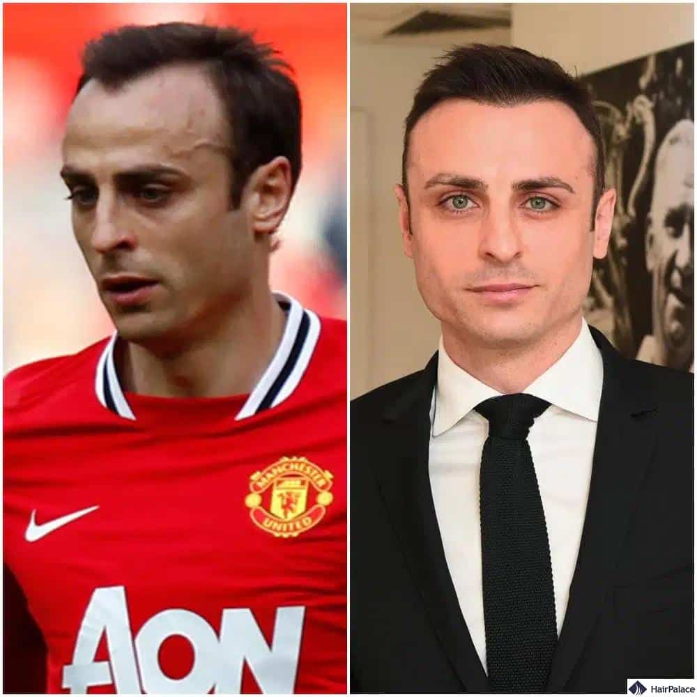 Dimitar Berbatov trapianto di capelli prima e dopo