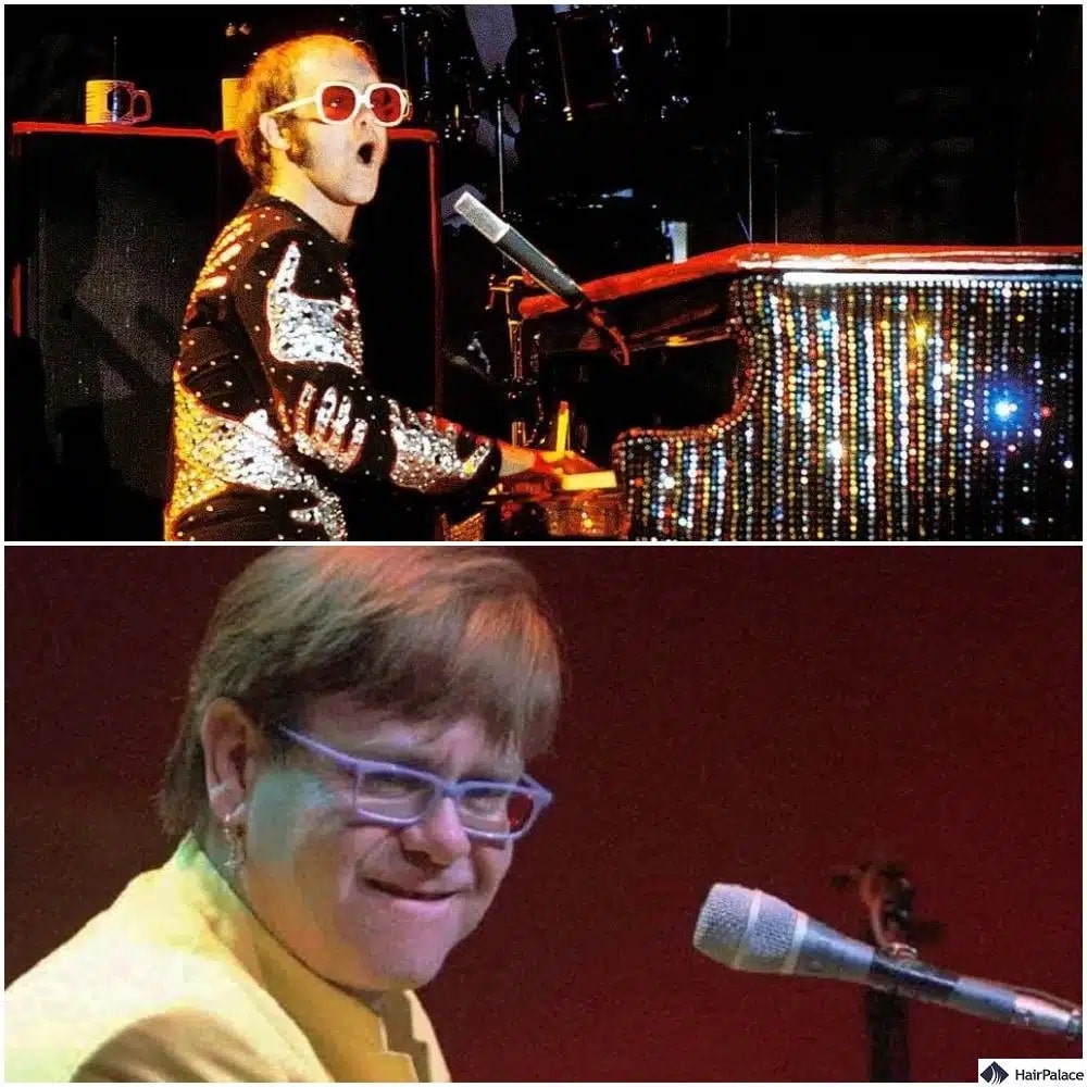 Trapianto capelli Elton John prima e dopo
