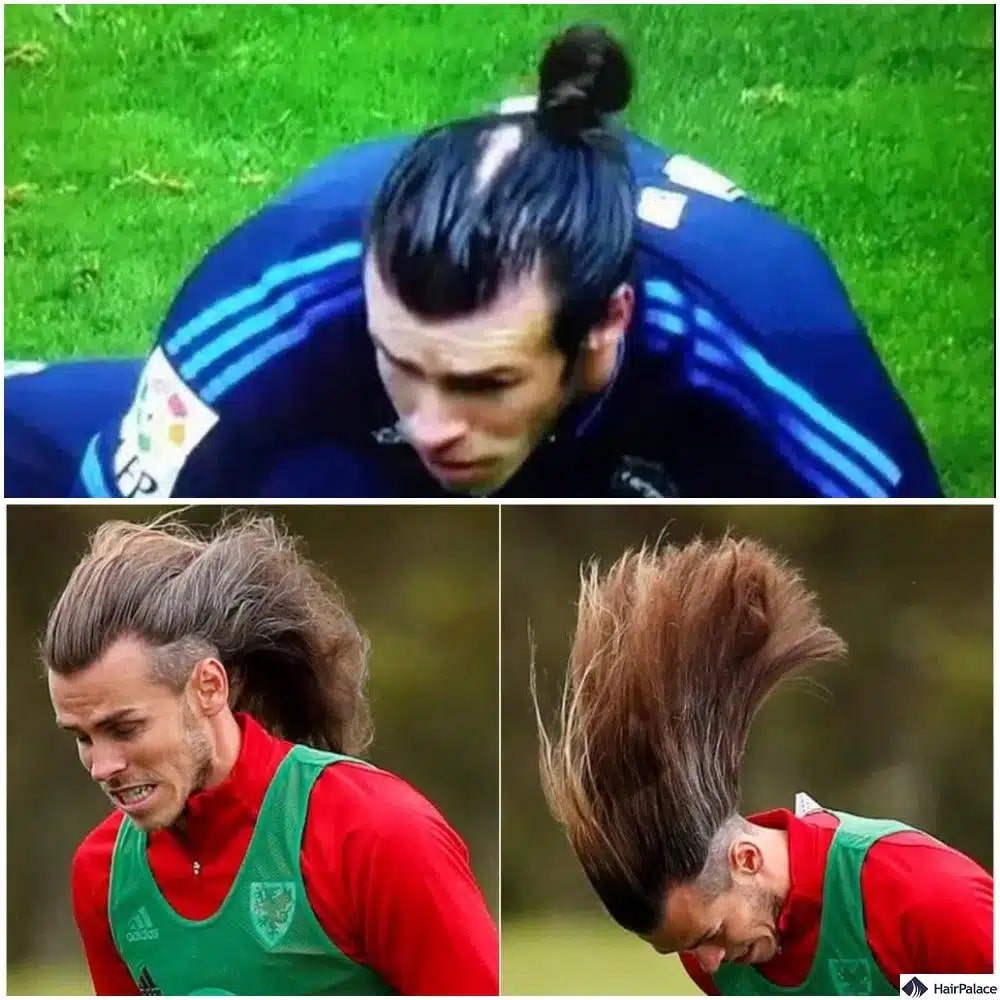Trapianto di capelli Gareth Bale prima e dopo