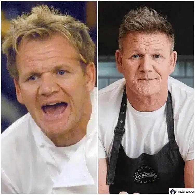 Trapianto di capelli Gordon Ramsay prima e dopo