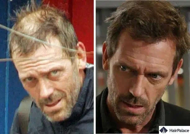Trapianto di capelli Hugh Laurie prima e dopo