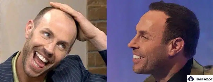 Trapianto di capelli Jason Gardiner prima e dopo