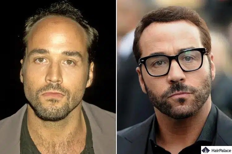 Trapianto capelli Jeremy Piven prima e dopo