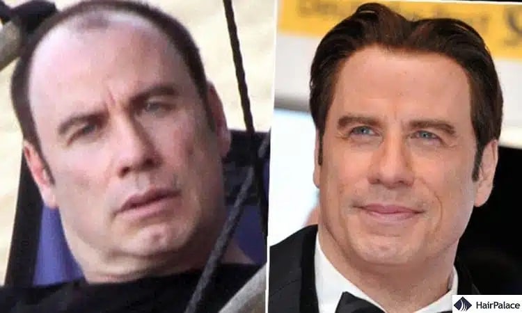 Trapianto di capelli John Travolta prima e dopo