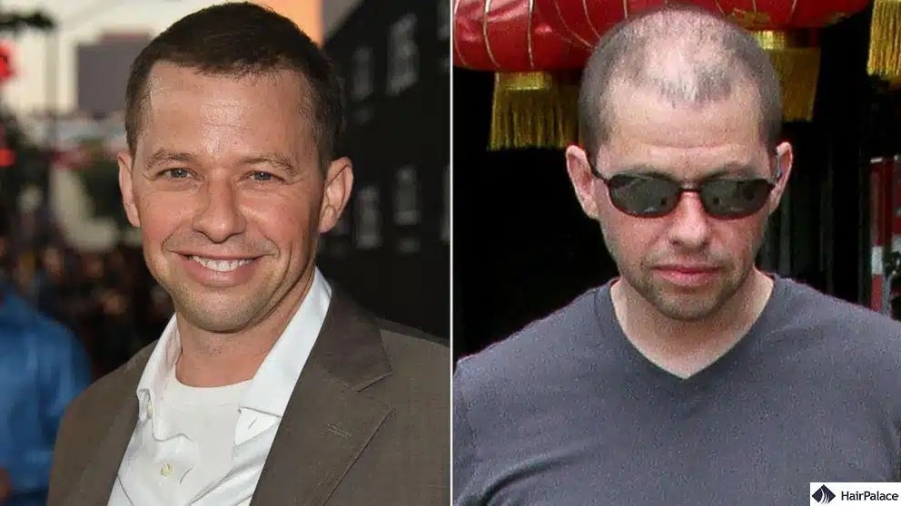 Trapianto di capelli Jon Cryer prima e dopo