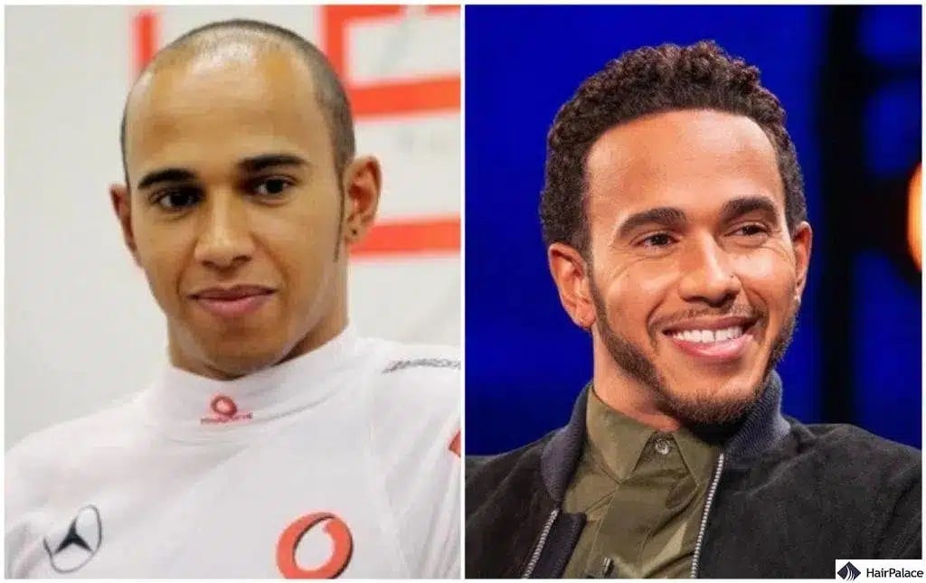 Trapianto di capelli Lewis Hamilton prima e dopo