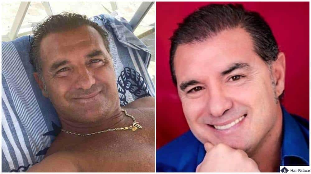 Lorenzo amoruso trapianto di capelli prima e dopo