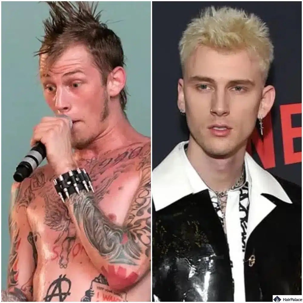 Trapianto di capelli Machine Gun Kelly prima e dopo