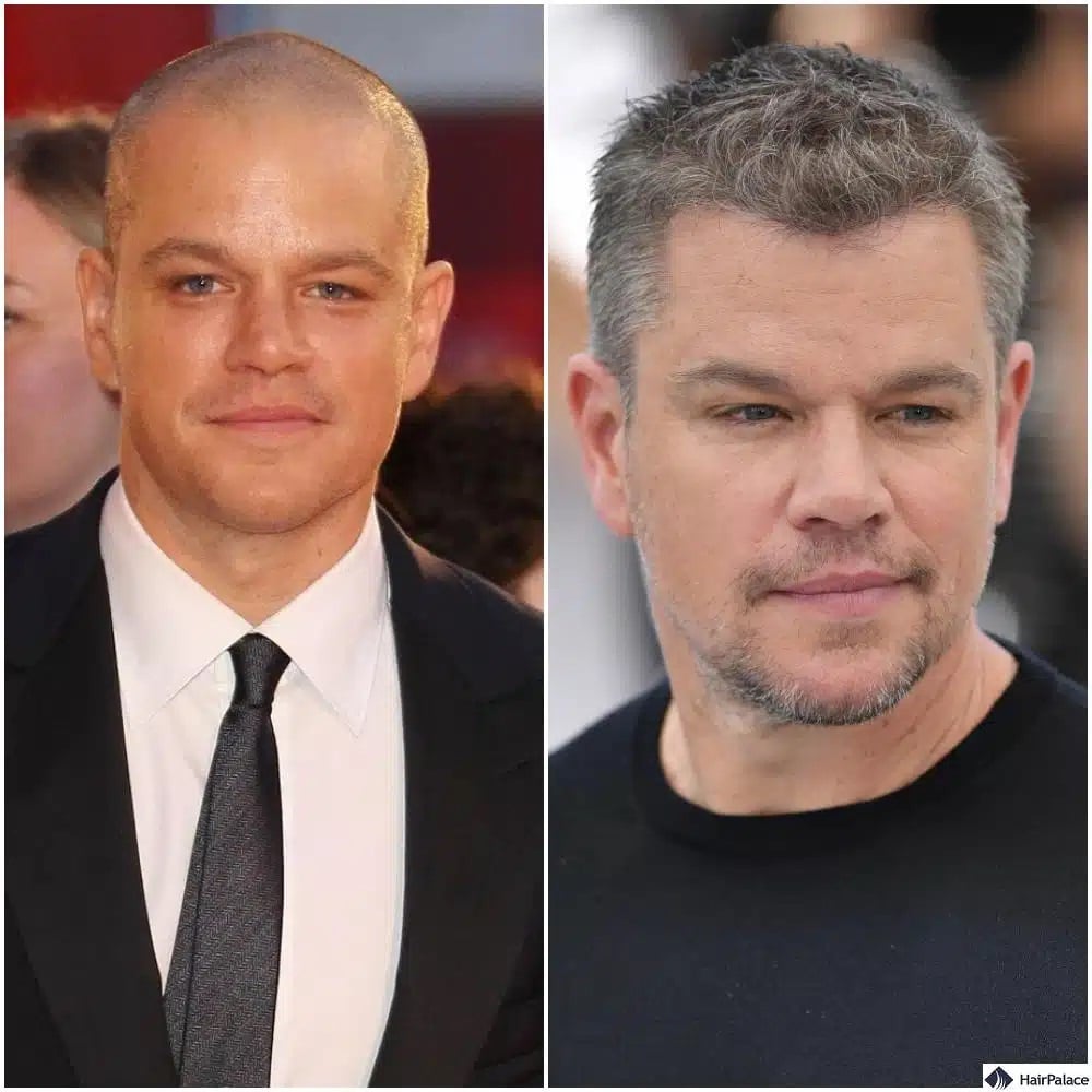 Trapianto di capelli Matt Damon prima e dopo