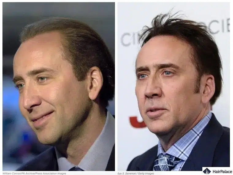 Trapianto di capelli Nicholas Cage prima e dopo