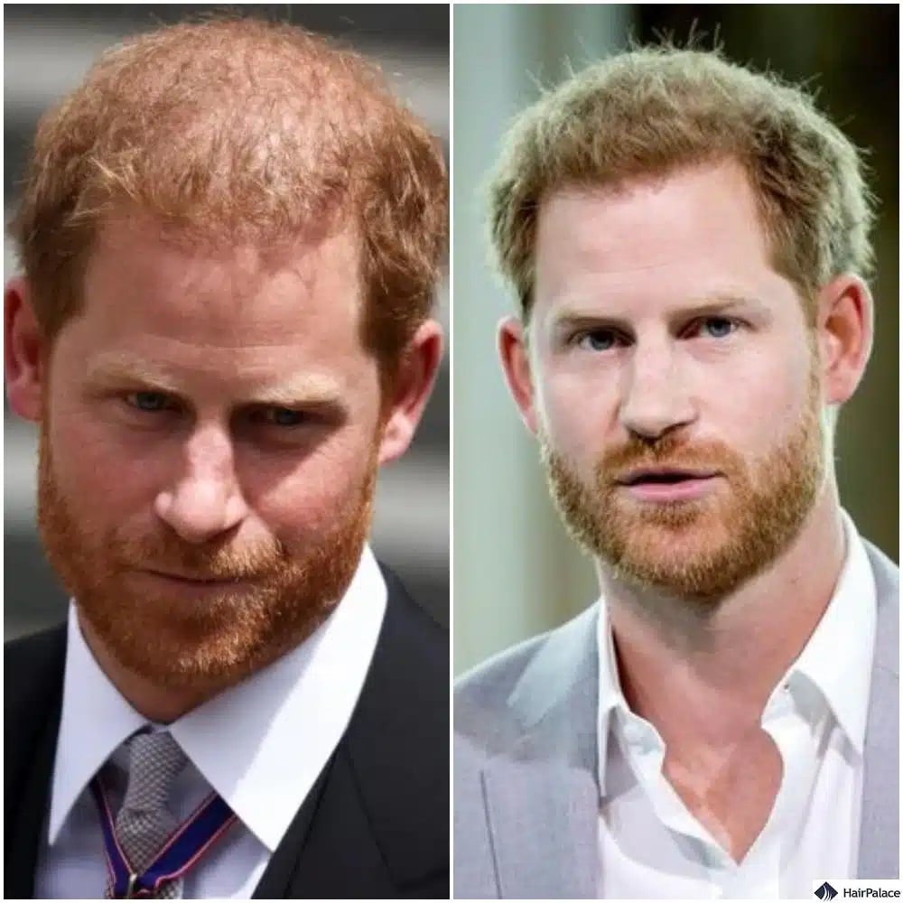 Trapianto capelli principe Harry prima e dopo