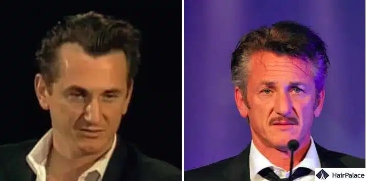 Trapianto di capelli Sean Penn prima e dopo