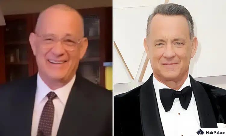 Trapianto di capelli di Tom Hanks prima e dopo