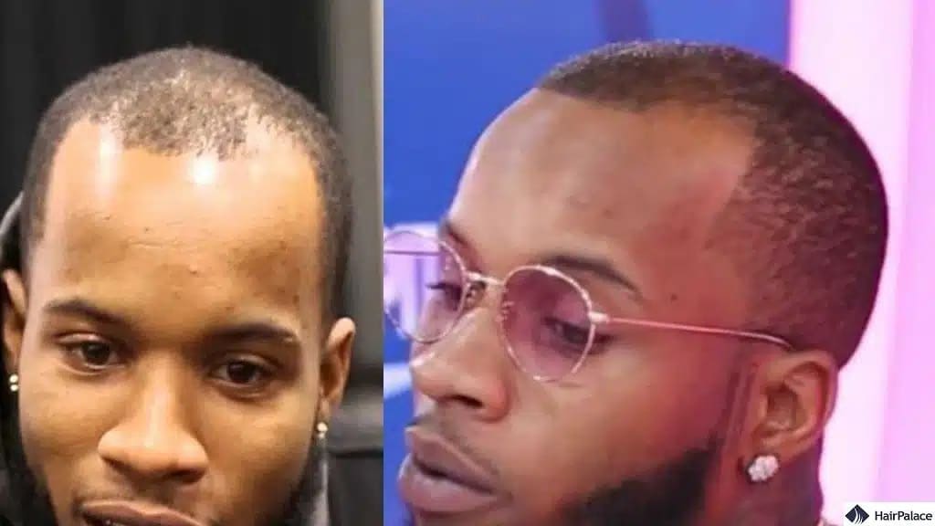 Trapianto di capelli Tory Lanez prima e dopo