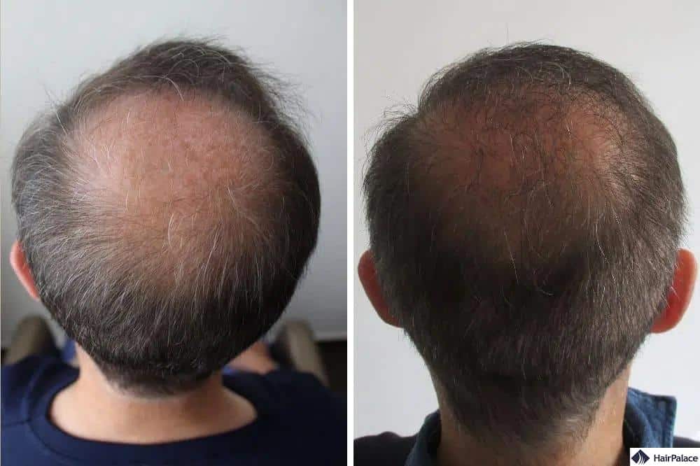 corona della testa prima e dopo il trapianto di capelli - HairPalace