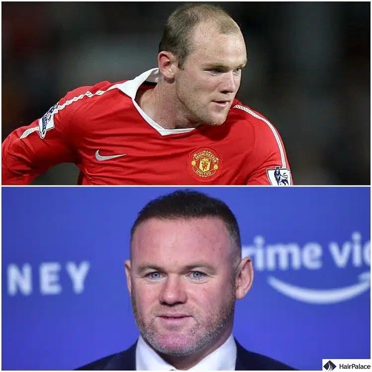 trapianto capelli wayne rooney prima e dopo