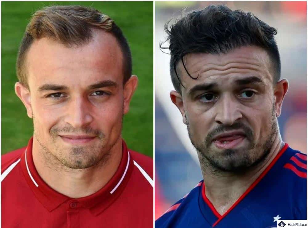 Xherdan Shaquiri trapianto di capelli prima e dopo