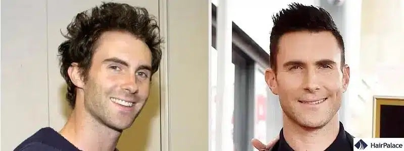 Trapianto di capelli Adam Lavine prima e dopo