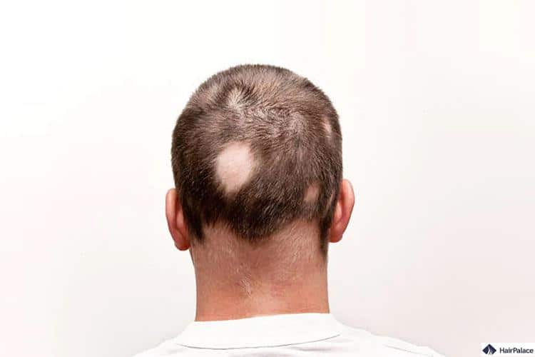 l'alopecia areata può caduta capelli cause