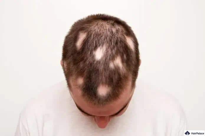 l'alopecia areata può essere la causa della calvizie
