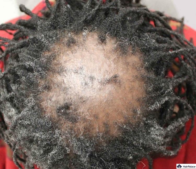 L'alopecia cicatriziale è una possibile causa di caduta dei capelli