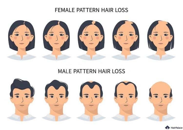 la calvizie femminile e maschile può causare la caduta dei capelli