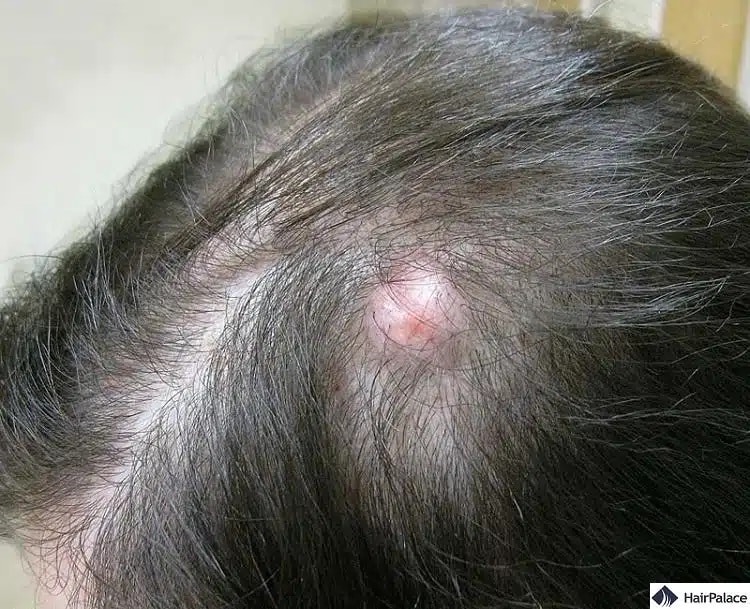 le cisti sono un pericoloso effetto collaterale del trapianto di capelli