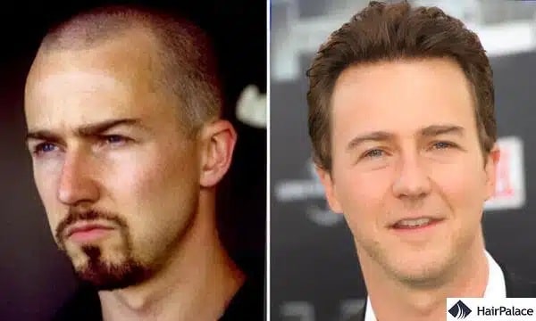 Trapianto di capelli Edward Norton prima e dopo