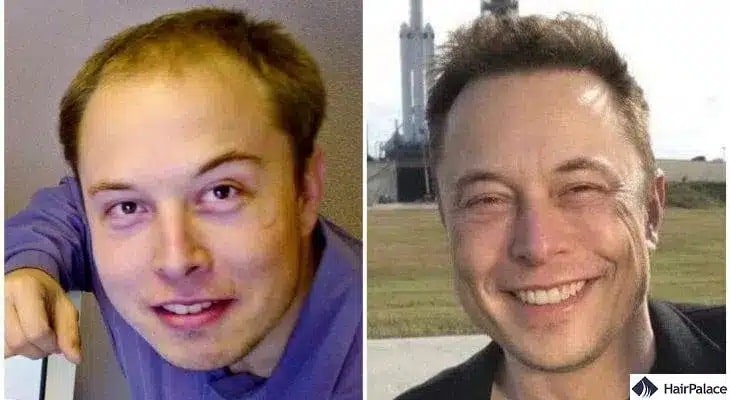 Trapianto di capelli Elon Musk prima e dopo