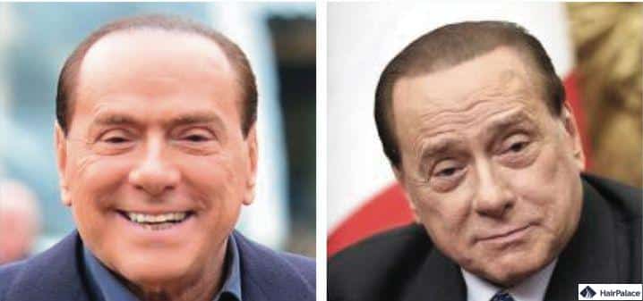 Silvio Berlusconi trapianto di capelli prima e dopo