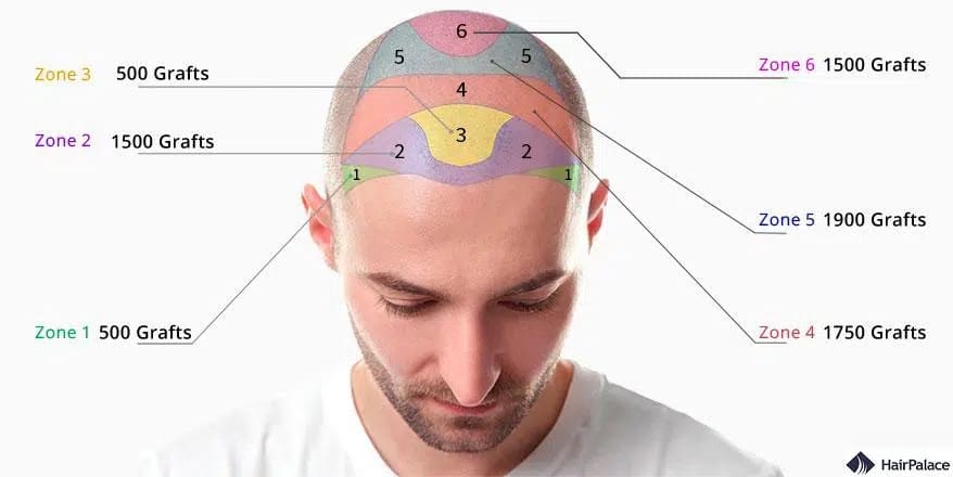 numero di innesti necessari per un trapianto di capelli