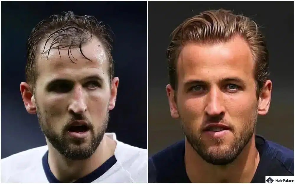 Trapianto capelli Harry Kane prima e dopo