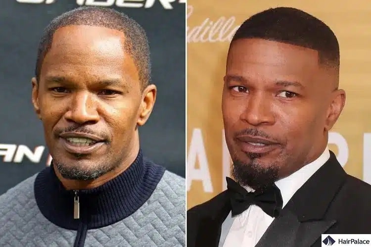 Trapianto di capelli Jamie Foxx prima e dopo