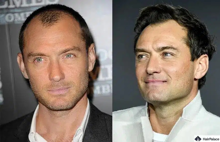 Jude Law trapianto di capelli prima e dopo