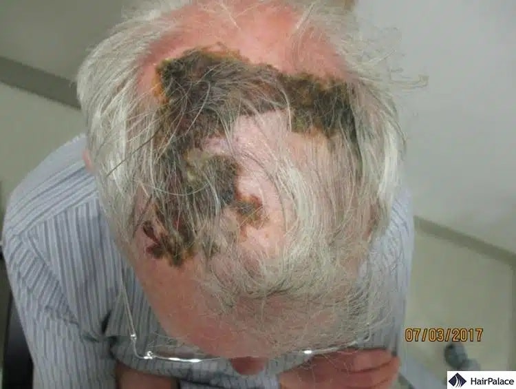 la necrosi del cuoio capelluto può essere un effetto collaterale di un trapianto di capelli fallito