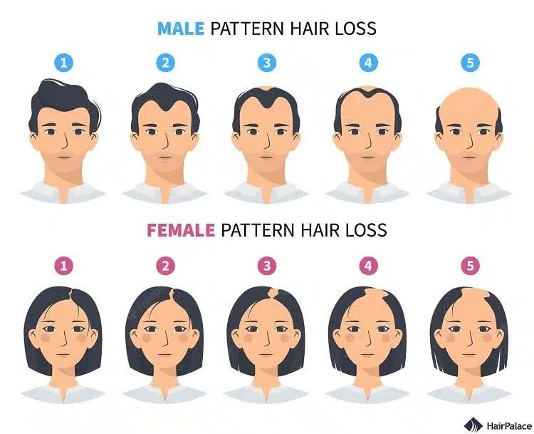 le differenze tra calvizie maschile e perdita di capelli femminile