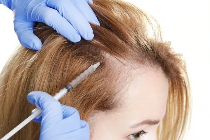 prp può essere un'alternativa per un trapianto di capelli femminile