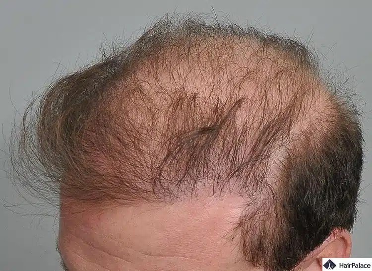un trapianto capelli andato male può provocare una scarsa crescita dei capelli