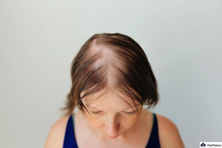 trattamento della caduta dei capelli causata da alopecia diffusa